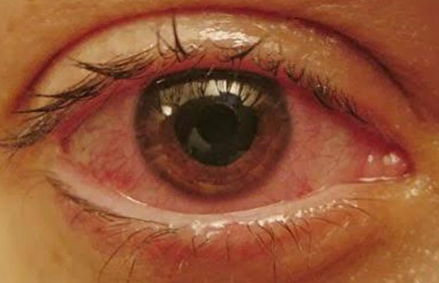 OCCHI ROSSI IN PISCINA? NON E' COLPA DEL CLORO. ECCO PERCHE' - 13/07/2015