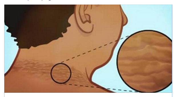 STRANI SEGNI SUL COLLO? ATTENZIONE, ECCO DA COSA POTRESTE ESSERE AFFETTI - 20/01/2016