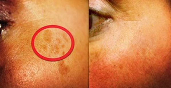 RIMEDIO NATURALE PER ELIMINARE LE MACCHIE SUL VISO - 22/06/2016