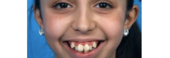 ''ADESSO MI PIACCIO''. ECCO COME LA CHIRURGIA HA TRASFORMATO IL VOLTO DI QUESTA VENTENNE - 24/07/2016
