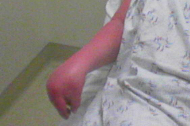 SI CHIAMA 'CRPS', UNA MALATTIA MISTERIOSA CHE COLPISCE ALL'IMPROVVISO, PIU' DOLOROSA DI UN AMPUTAZIONE - FOTO - 19/11/2013