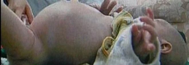 BIMBO DI 2 ANNI HA IL PANCIONE: ''PARTORISCE'' IL GEMELLO PARASSITA - VIDEO - 02/10/2013