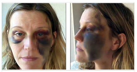 PICCHIATA DAL MARITO DOPO IL PARTO CESAREO, IL MOTIVO E' DAVVERO ASSURDO - 24/12/2016