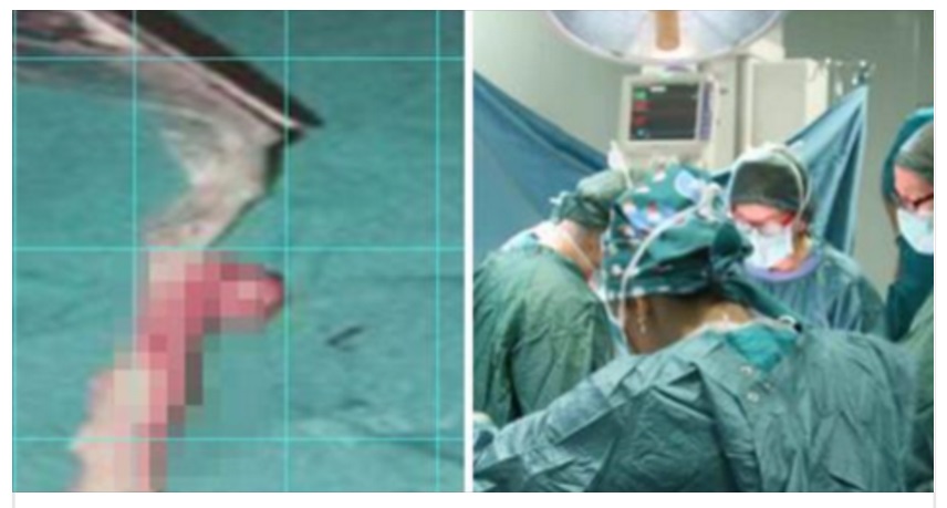 I MEDICI PENSAVANO FOSSE APPENDICITE, POI L'IMBARAZZANTE SCOPERTA NELLO STOMACO DELLA RAGAZZA - 02/01/2017