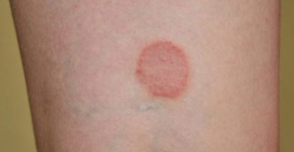 FA PIU' VITTIME DEL CANCRO E DELLA MALARIA. LA MALATTIA CHE STA SCONVOLGENDO GLI SCIENZIATI - 27/01/2017