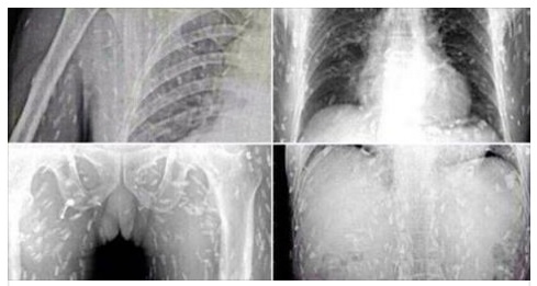 MANGIA IL SUSHI, SI SENTE MALE E VA DAL MEDICO HA IL CORPO INVASO DAI VERMI: ''ECCO IL CIBO DA EVITARE ASSOLUTAMENTE'' - 02/03/2017