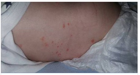 ''LA MENINGITE NON INIZIA SEMPRE COME DICONO'' UNA MAMMA LANCIA L'ALLERTA - FATE MOLTA ATTENZIONE - 14/03/2017
