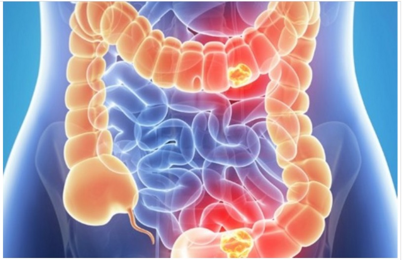 PURIFICA IL COLON E PERDI 8 KG: ECCO IL MODO SEMPLICE PER POTERLO FARE - 27/03/2017