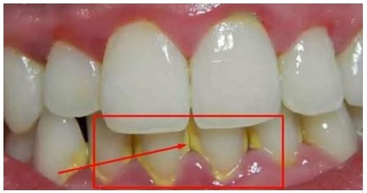 ELIMINARE LA PLACCA IN MODO NATURALE IN 5 MINUTI SENZA ANDARE DAL DENTISTA - 04/05/2017
