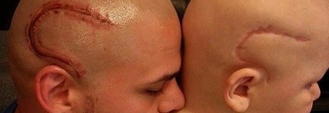 PADRE SI FA TATUARE CICATRICE IN TESTA PER ASSOMIGLIARE AL FIGLIO OPERATO AL CERVELLO - 21/06/2016