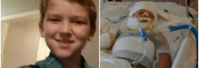 I BULLI GLI DANNO FUOCO CON LA BENZINA, BAMBINO DI 10 ANNI ORA LOTTA TRA LA VITA E LA MORTE - 06/10/2016