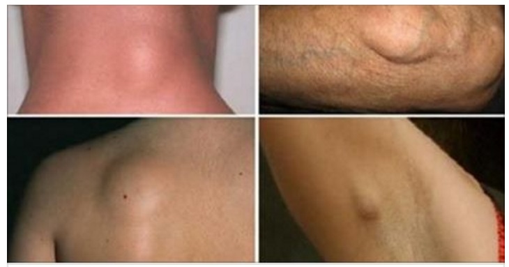 LIPOMI - ECCO COME ELIMINARLI IN MODO NATURALE SENZA RICORRERE ALLA CHIRURGIA - 19/06/2017