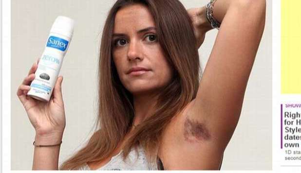 DEO SPRAY LE USTIONA LE ASCELLE. 'HO  SENTITO UN DOLORE FORTISSIMO' - 06/08/2012