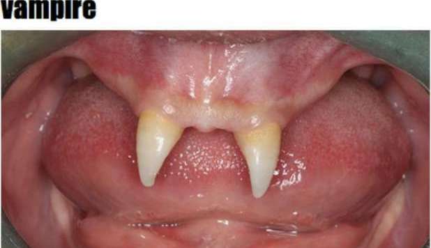 HA DUE DENTI DA VAMPIRO: I MEDICI NON SANNO DARE SPIEGAZIONI - FOTO - 29/12/2012
