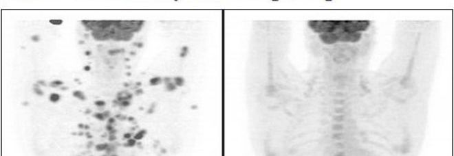 HA 70 TUMORI LETALI IN TUTTO IL CORPO: ''SONO RIUSCITO A GUARIRE IN 2 SETTIMANE'' - ECCO COME - 26/02/2014