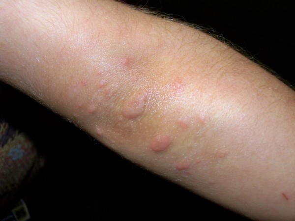 LO SAPEVATE CHE SECONDO DOVE AVETE L'ACNE SUL VOSTRO CORPO POTETE CAPIRE QUALI PROBLEMI DI SALUTE AVETE? - 28/06/2016