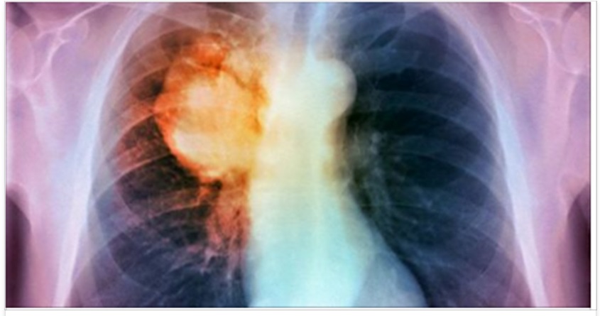 RIDUCE DEL 40% IL RISCHIO DI MORTE: ECCO IL NEMICO DEL CANCRO AI POLMONI - 10/10/2016
