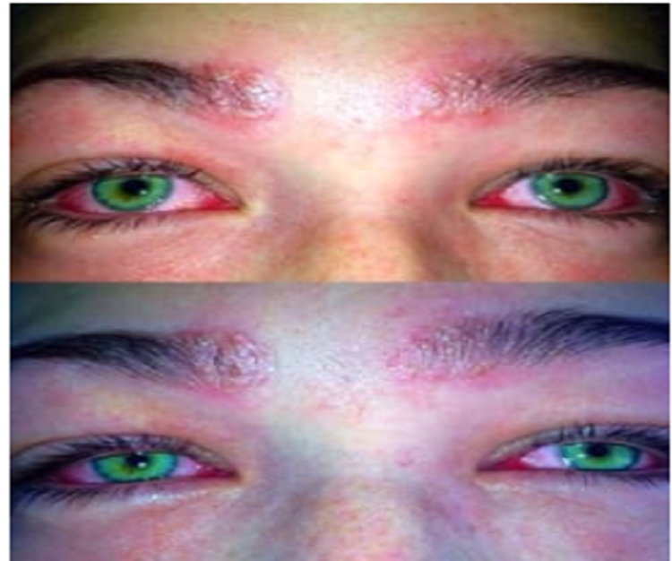 RAGAZZA AUSTRALIANA RISCHIA DI DIVENTARE CIECA: ''ATTENTE, LO FACCIAMO TUTTE OGNI MESE'' - 18/02/2017