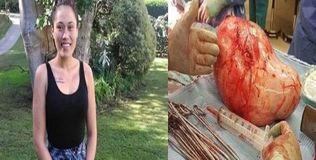 ''PENSAVO DI ESSERE INCINTA'': DALLA PANCIA ESCE QUALCOSA DI MOSTRUOSO - 23/05/2017