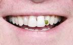 SEI SIMPATICO COME I FILI DE 'A CICORIA CHE TE SE INFILANO IN MEZZO AI DENTI !! - 29/04/2012