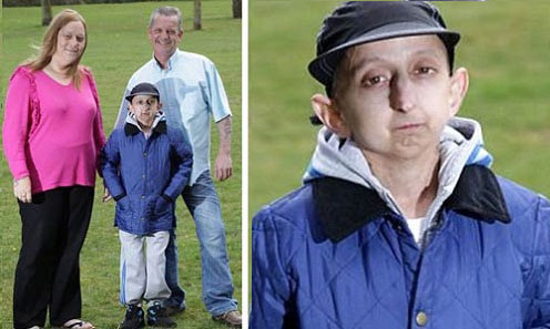 Rarissima malattia per ragazzo ventenne con corpo di un 160enne - 25/12/2012