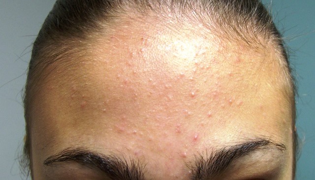 SCOPRE DI AVERE IL CANCRO GUARDANDO UN BRUFOLO SUL VISO. ECCO COME ERA FATTO - 02/10/2015