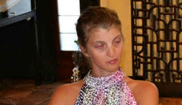 UNA MALATTIA RARA LE DEFORMA IL VISO: GIULIA SCRIVE TUTTO SU UN BLOG - 23/07/2012
