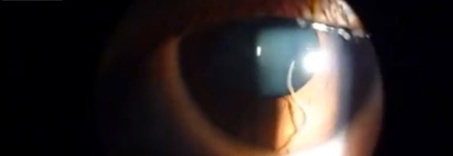 LA RAGAZZA CON IL PARASSITA NELL'OCCHIO: ''COLPA DELLE LENTI A CONTATTO SPORCHE'' - VIDEO - 27/05/2013