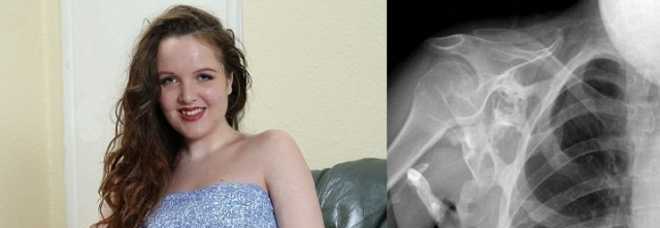 17 ANNI, VIVE COME UNA STATUA: LA MALATTIA LE TRASFORMA I MUSCOLI IN OSSA - FOTO - 30/07/2013