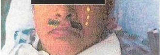 LE DISEGNANO I BAFFI MENTRE È SOTTO ANESTESIA, LEI DENUNCIA L'OSPEDALE - 08/09/2013