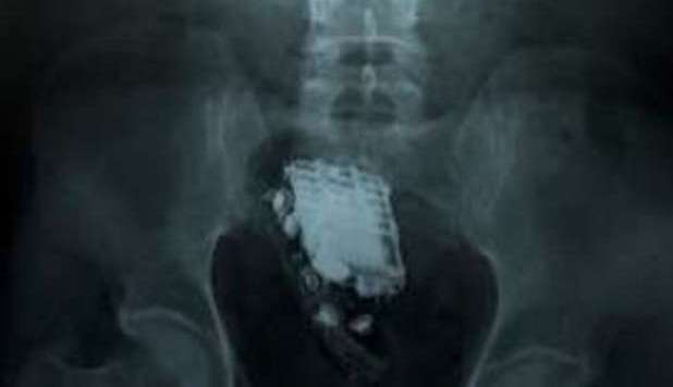 DETENUTO NASCONDE IL CELLULARE NEL RETTO, UNO SQUILLO LO TRADISCE - 10/02/2013