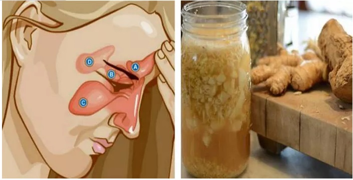 MESCOLATE 2 INGREDIENTI PER DIRE ADDIO ALLA SINUSITE, CATARRO E INFLUENZA: UN RIMEDIO VELOCE E FANTASTICO - 12/01/2017