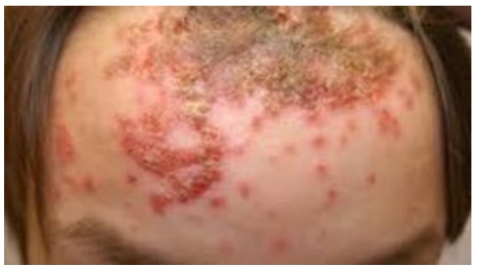 ALLARME SULLE SPIAGGE ITALIANE: ATTENZIONE AL VIRUS CHE DISTRUGGE LA PELLE - 01/08/2016