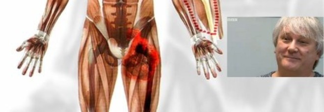 GLI INNESTANO UN POLPACCIO NEL BRACCIO: COSÌ I MEDICI L'HANNO SALVATO DAL TUMORE - 05/03/2014