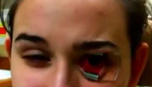 LENTI A CONTATTO SPORCHE: RISCHIA LA CECITÀ A 18 ANNI - VIDEO - 28/03/2013