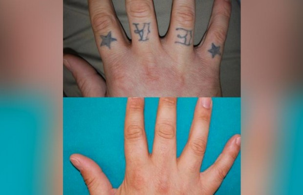 RIMOZIONE DEI TATUAGGI: ECCO LE 11 COSE CHE E' MEGLIO SAPERE - 10/07/2015