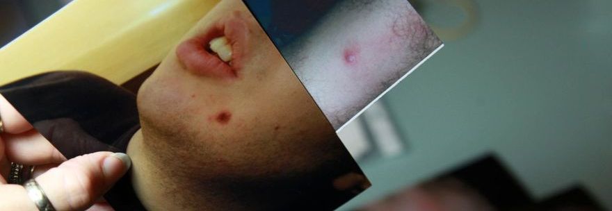 Bullismo a scuola: ''Da 4 anni spengono sigarette sul corpo di mio figlio disabile'' - Foto all'interno - 14/11/2013