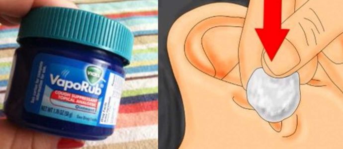 METTETE DEL VAPORUB SU UN BATUFFOLO DI COTONE E METTETELO NELLE ORECCHIE PER UN RISULTATO STUPEFACENTE - 26/10/2016