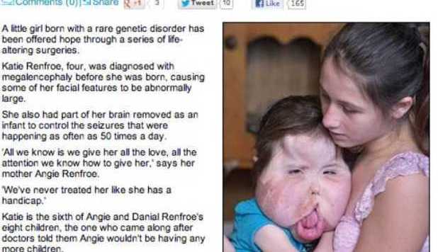 L'INCUBO DI KATIE: UN MALE A 4 ANNI LE RENDE LE GUANCE GIGANTI - 19/12/2012