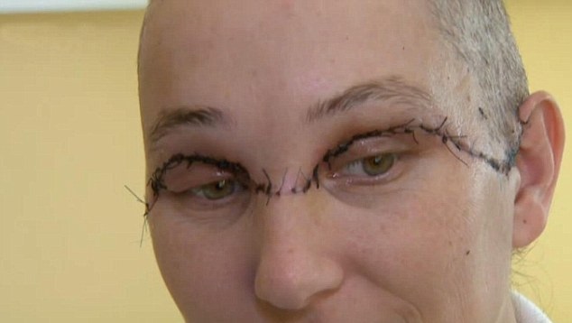 E' SALVA GRAZIE AD UN CAPOLAVORO DELLA CHIRURGIA. TUTTO PER COLPA DI UN BANALE INCIDENTE DOMESTICO - 26/02/2015