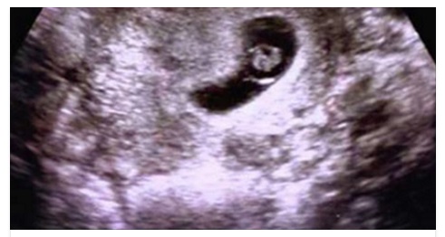 DECIDE DI ABORTIRE, MA 9 SETTIMANE DOPO L'ABORTO LA SCOPERTA SHOCK - 10/05/2016