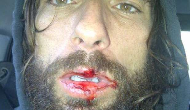 BRUMOTTI, INCIDENTE IN BICI. LA FOTO SU TWITTER: 'NON MI VISITAVANO' - 10/01/2013