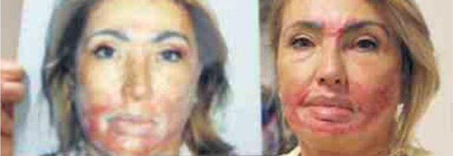 LE SBAGLIANO IL PEELING: DONNA SFIGURATA CON ACIDO E LASER - FOTO - 15/09/2013