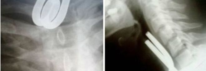 VA IN OSPEDALE CON UN FORTE MAL DI GOLA: I MEDICI FANNO UNA SCOPERTA SCIOCCANTE - 01/01/2015