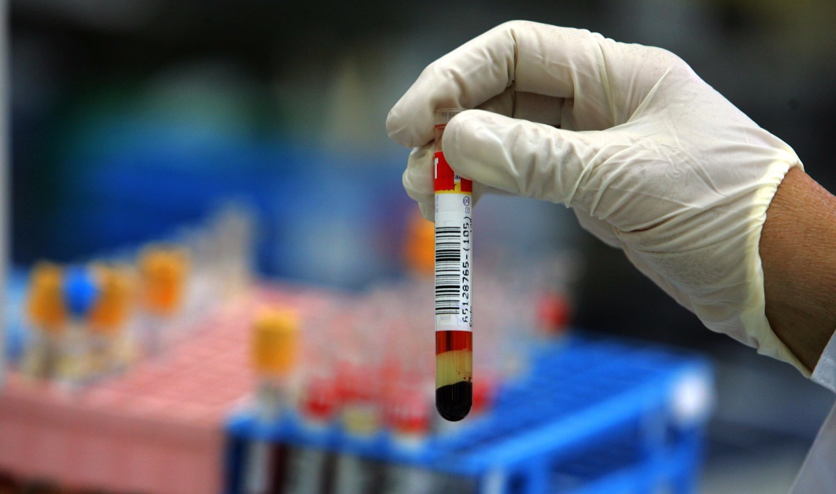 BASTERA' UN ESAME DEL SANGUE PER SCOPRIRE LA PRESENZA DI UN TUMORE E IN QUALE PARTE DEL CORPO - 08/03/2017