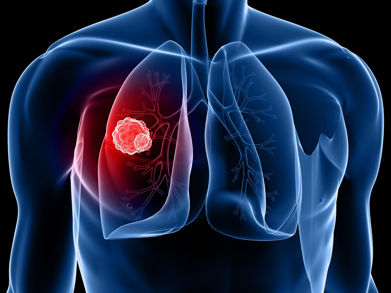 CANCRO AI POLMONI, CREATO UN DISPOSITIVO DIAGNOSTICO CHE LO RILEVA DAL RESPIRO - 10/10/2015