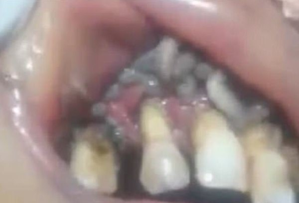 HA LA BOCCA PIENA DI VERMI: IL DENTISTA NON CREDE AI PROPRI OCCHI - VIDEO - 24/10/2017