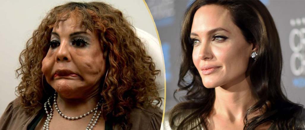CEMENTO NEL VISO PER ASSOMIGLIARE AD ANGELINA JOLIE: ''MI SONO FIDATA DI UN MEDICO CHE MI HA ROVINATA'' - 21/04/2017