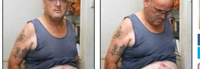 UN PARASSITA GLI GONFIA LO STOMACO, NON SI TROVA UNA CURA, RICRESCE SEMPRE - 09/12/2013