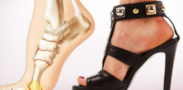 IL PERICOLO NASCOSTO DIETRO I TACCHI: ECCO COSA SUCCEDE QUANDO UNA DONNA CAMMINA PIU' DI 2 ORE CON I TACCHI - 11/11/2015